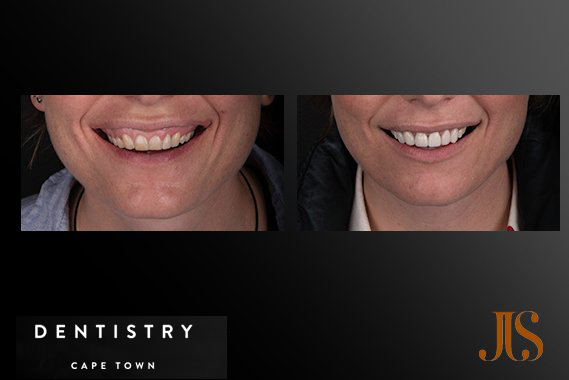 Cosmetic Dentistry Cape Town Cosmetic Dentistry