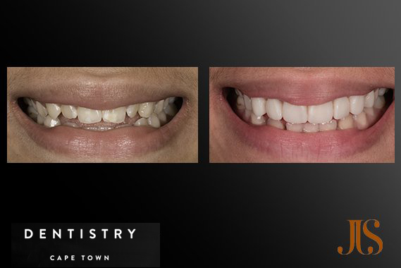 Cosmetic Dentistry South Africa