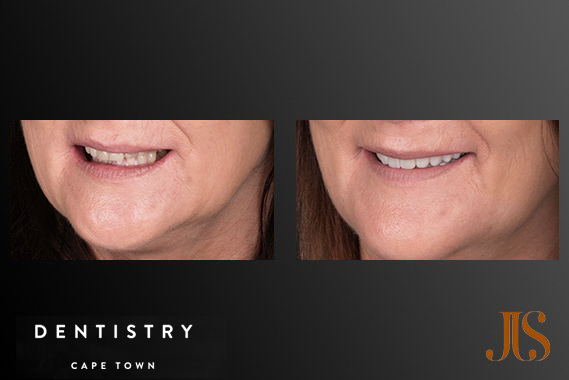 Dental Reconstruction Hollywood Smile