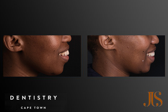 Invisalign Cape Town