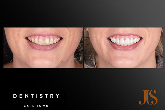 Cosmetic Dentistry Cape Town Cosmetic Dentistry
