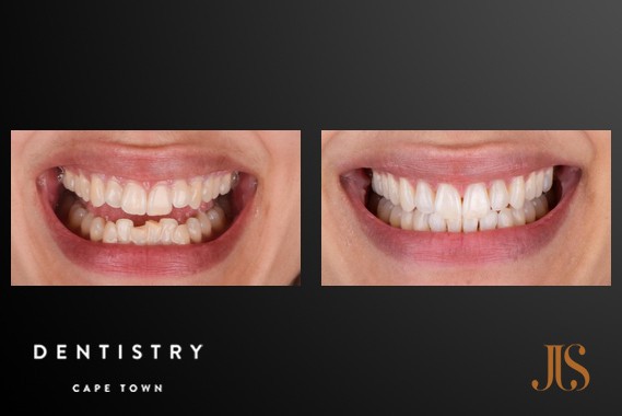Smile Makeover Cape Town