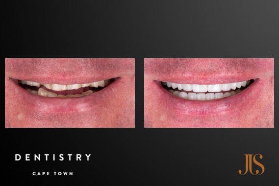 Smile Makeover Cape Town