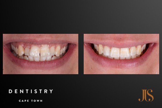 Smile Makeover Cape Town