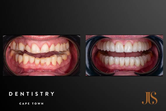 Smile Makeover Cape Town