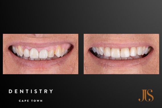 Smile Makeover Cape Town