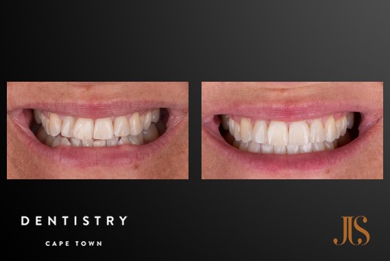 Smile Makeover Cape Town