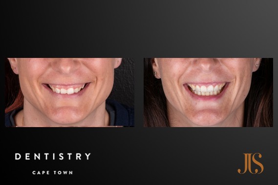 Smile Makeover Cape Town