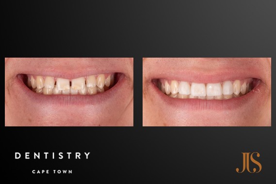 Smile Makeover Cape Town