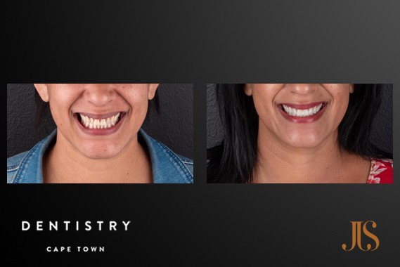 Smile Makeover Cape Town