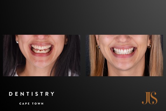 Smile Makeover Cape Town