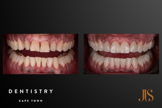Smile Makeover Cape Town
