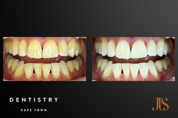 Teeth Whitening Cape Town