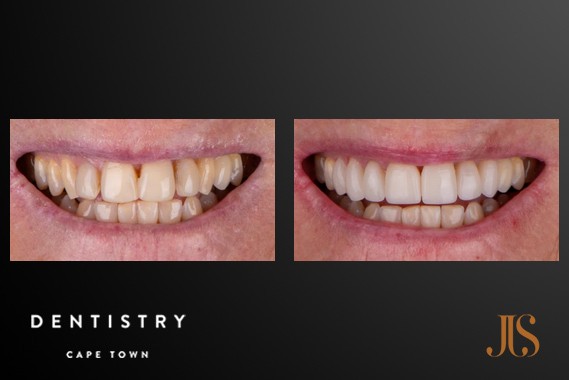 Teeth Whitening Cape Town