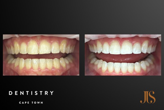 Teeth Whitening Cape Town