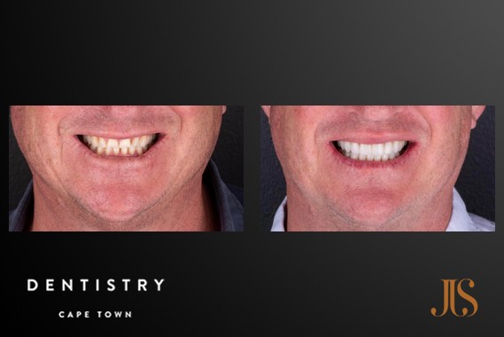 Teeth Whitening Cape Town
