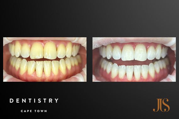 Teeth Whitening Cape Town