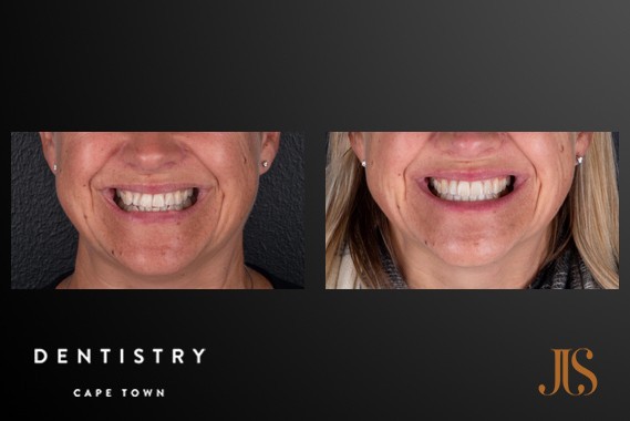Teeth Whitening Cape Town
