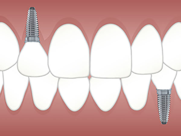 Dental Implants Cape Town | JJS Dentistry
