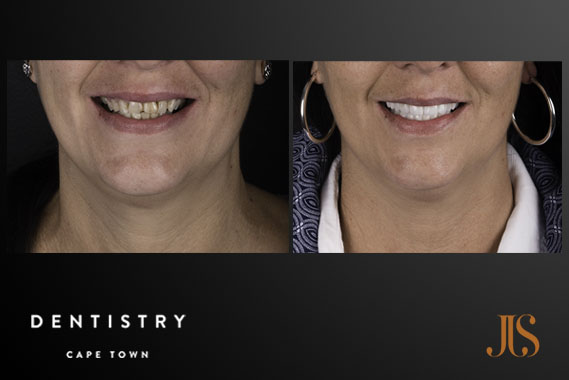 Dental Implants | JJS Dentistry