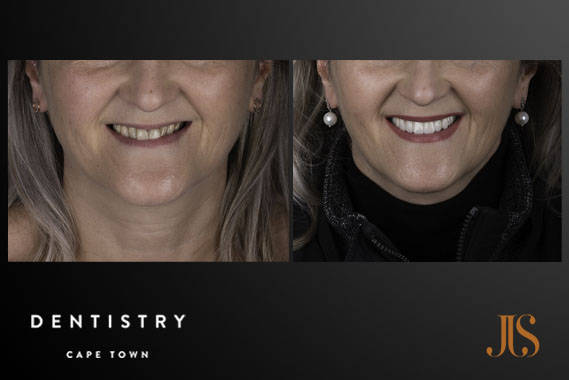 Dental Implants | Dr JJ Serfontein