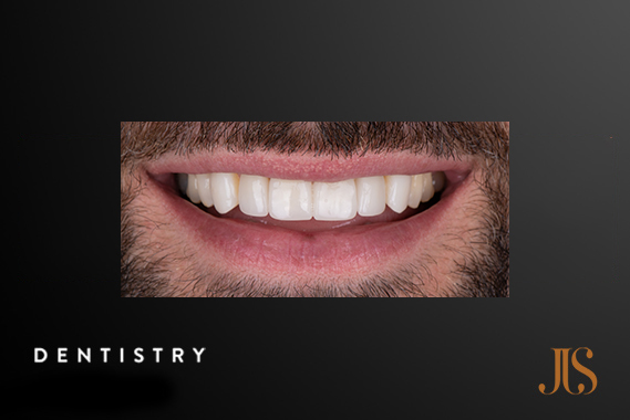 TM Joint and Bruxism