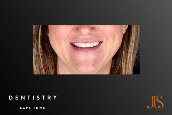 Cosmetic Dentistry Cape Town