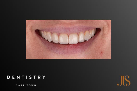 Cosmetic Dentistry Cape Town