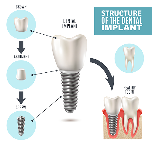 How do dental implants work?