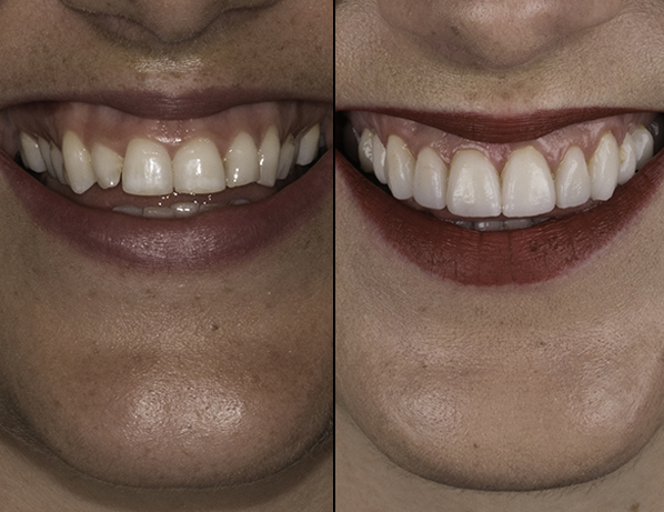 Smile Makeover Cape Town | Dr JJ Serfontein