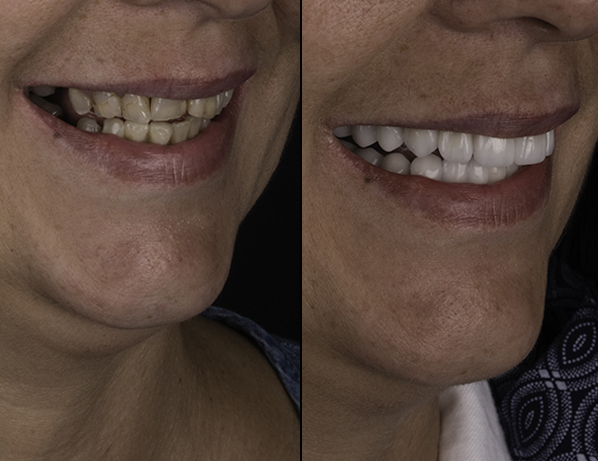 Smile Makeover Cape Town | Dr JJ Serfontein